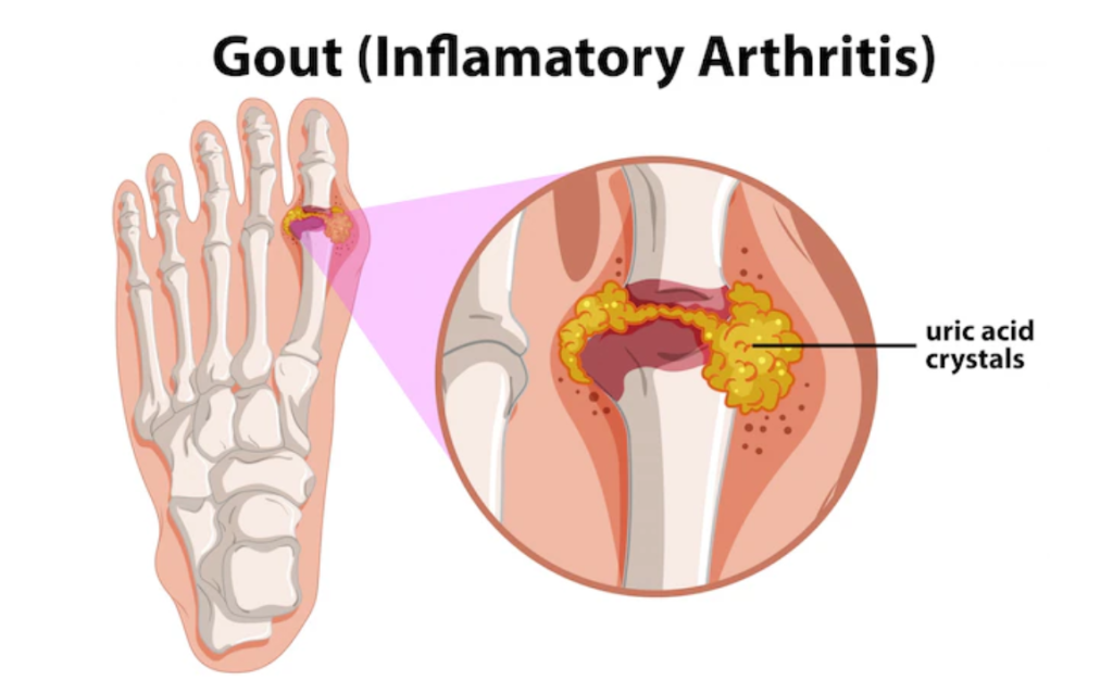 hình minh họa bệnh gout